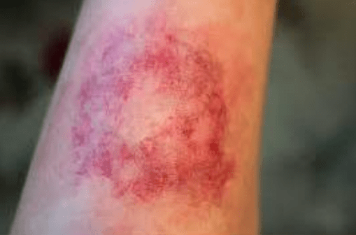 Why do women bruise so easily as especially compared to men